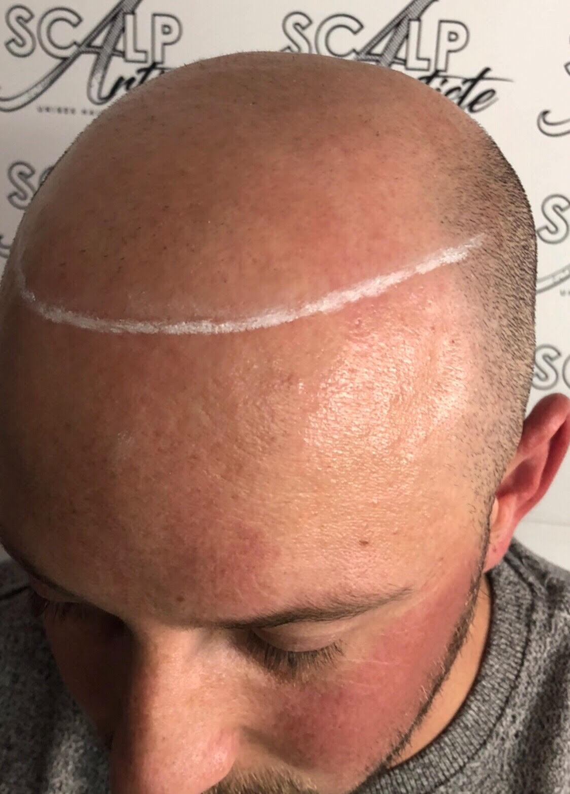 scalp